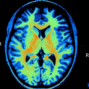 Multicolored brain scan on computer screen 