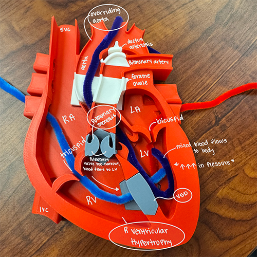 A model heart sits on a desk, and the configuration shows a heart defect, the tetralogy of fallot. Overlaying the photo, a student has labeled various parts of the heart. Red, blue and purple pipe cleaners are threaded through the circulatory pathways.